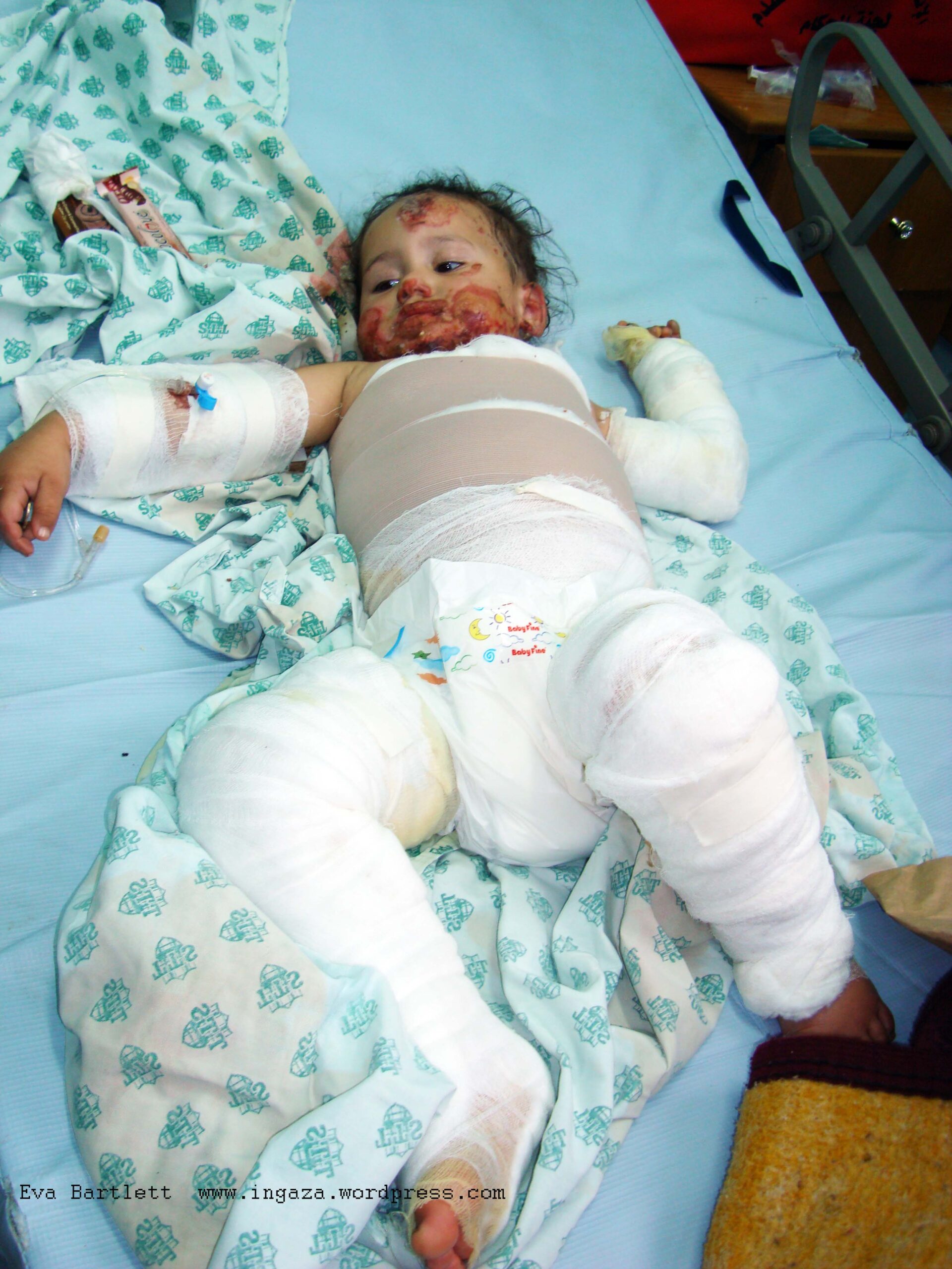 Six members of Farah's family were killed by Israeli-fired white phosphorous in January 2009. The 3 year old sustained white phosphorous burns over 22% of her body area.